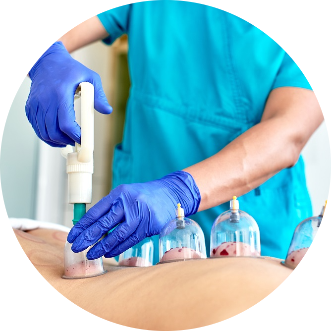 Hijama